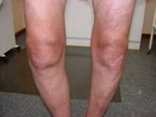 Symptomer vun Arthrosis vum Knéi Gelenk