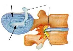 Zerstéierung vum fibrous Ring mat cervical Osteochonds