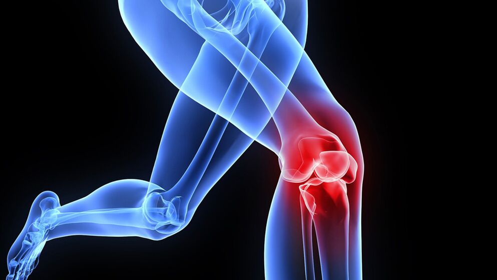 Problemer mat de Knéien duerch Arthrosis