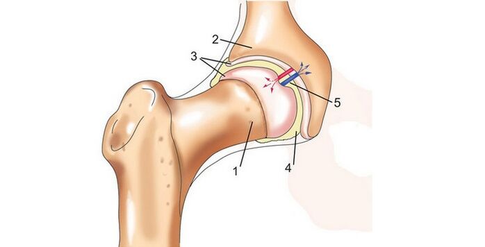 Hip Gelenk an Arthrosis