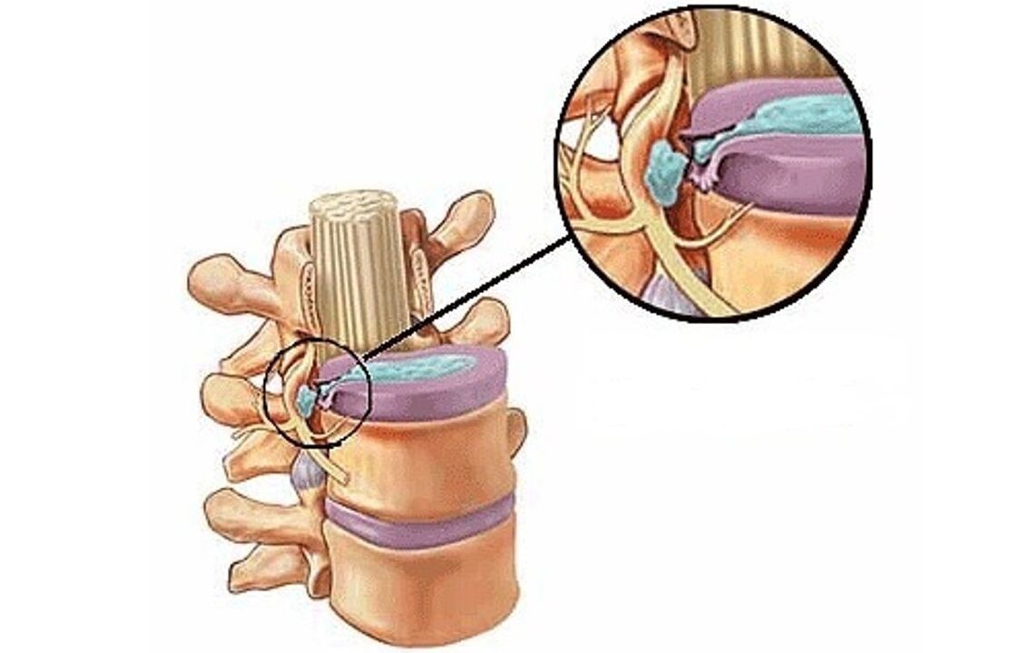 intervertebral Hernia mat thoracesch Osteochondrose
